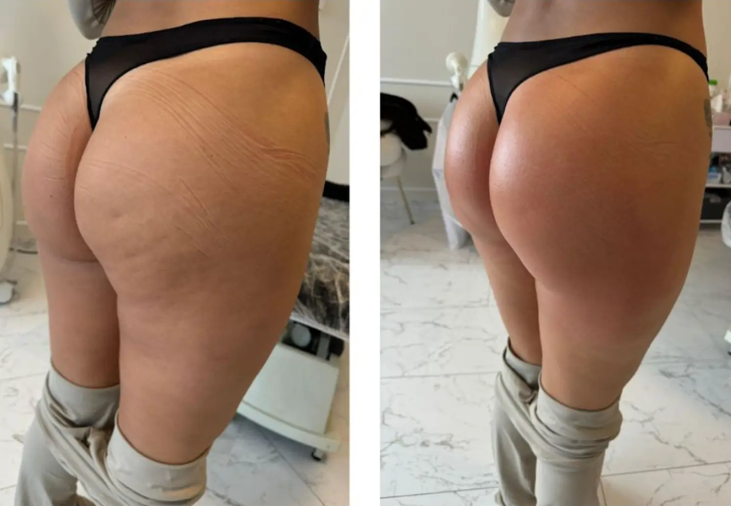 Before and after results after 1 session with the Artemis T-Shape 2 in Miami, FL.