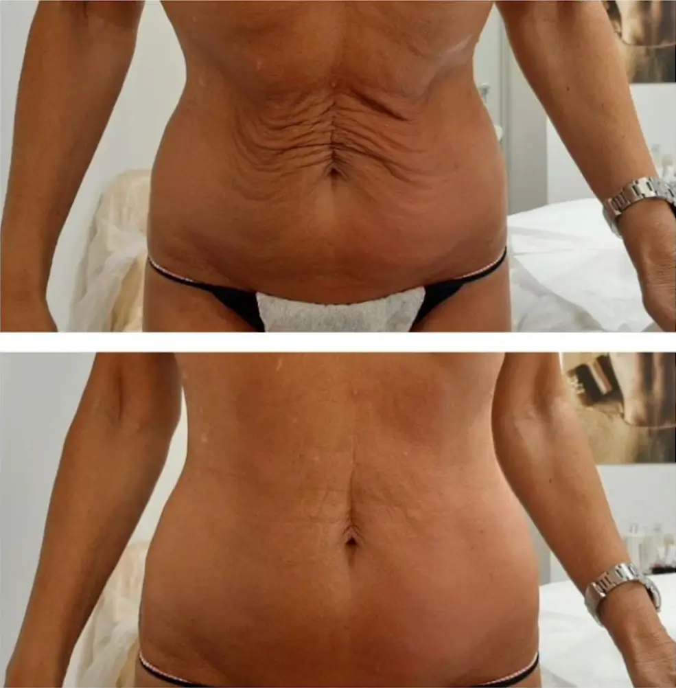 Miami T-Shape 2 abdomen skin tightening after 3 treatments at Casa Privee.