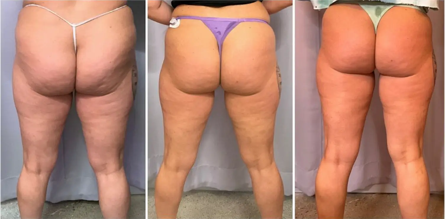 Results after 3 sessions with the Artemis T-Shape 2 at Casa Privee in Miami, Florida.